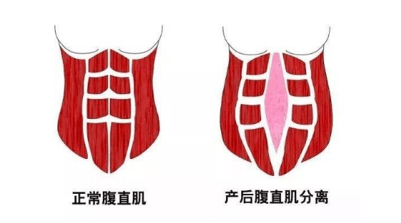 产后恢复加盟，腹直肌修护的重要性