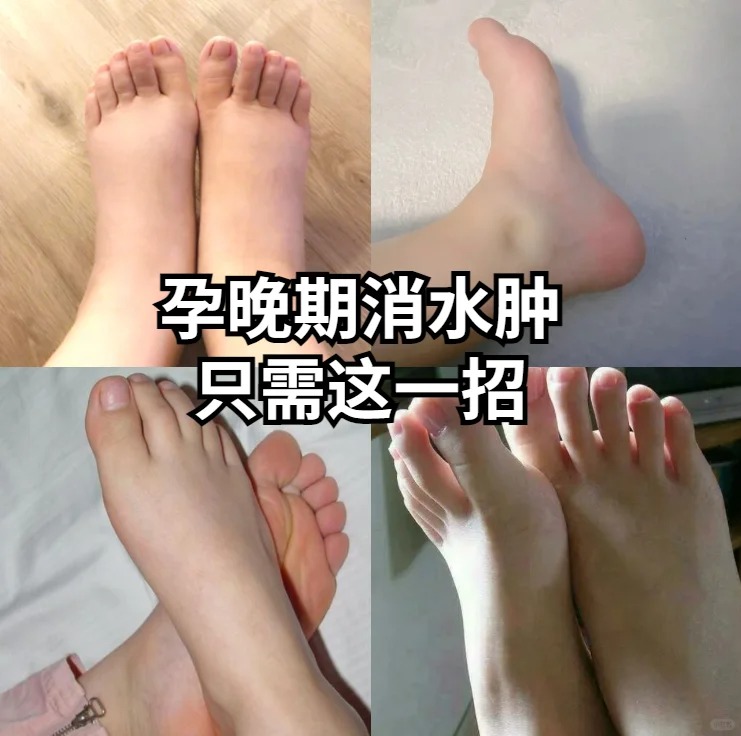 孕期保养小秘诀_一招解决孕期水肿_1_漂亮妈妈孕产护理连锁品牌_来自小红书网页版.jpg