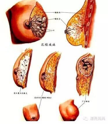 1,乳腺纤维腺瘤