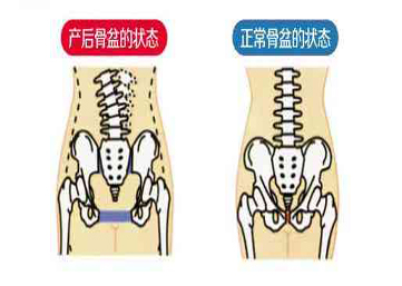 产后新妈妈应及早进行盆底康复预防疾病